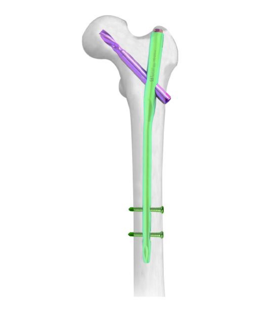 PFNA стрижень для проксимального відділу стегна Double medical technology